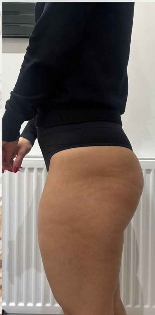 Side view before a 3D Ultimate Pro bum lift session at Precious Moments Beauty Clinic, Banstead