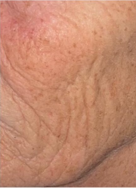 Close-up of crepey, finely lined cheek skin before 3D Dermaforce radio-frequency skin needling at Precious Moments Beauty Clinic, Banstead