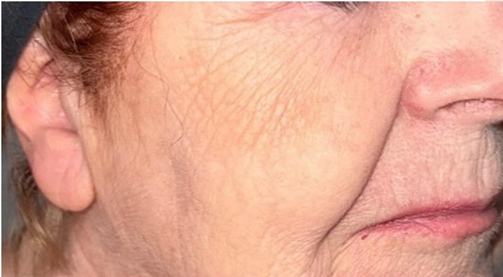Deep lines and creping across the cheek and eye area before a course of Dermaforce treatments in Banstead